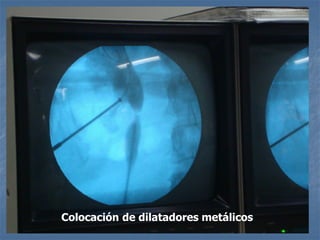 Colocación de dilatadores metálicos
 