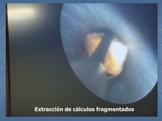 Extracción de cálculos fragmentados
 
