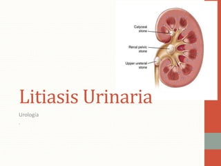 Litiasis Urinaria
Urología
.
 