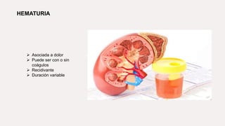 HEMATURIA
 Asociada a dolor
 Puede ser con o sin
coágulos
 Recidivante
 Duración variable
 