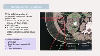 Nefrolitectomía Percutánea
TC de abdomen y pelvis sin
contraste es de elección para la
planificación
• Claculos > 1,5 cm en cáliz
inferior o > 2 cm renales
• Coraliformes
• <2 cm concaracteristicas
desfavorables para otros
métodos (malformaciones, litiasis
duras,..)
Contraindicaciones:
• Embarazo
• Desórdenes de coagulación
• ITU
• Colon retrorrenal
 