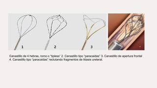 Canastillo de 4 hebras, romo o “tipless” 2. Canastillo tipo “paracaidas” 3. Canastillo de apertura frontal
4. Canastillo tipo “paracaidas” reclutando fragmentos de litiasis ureteral.
 