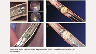 Dispositivos anti migratorios de fragmentos de litiasis ureterales durante litotripsia
endoscópica
 