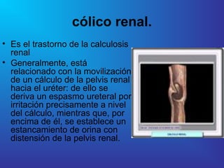 LITIASIS URINARIA, litiasis urinaria urinaria | PPT