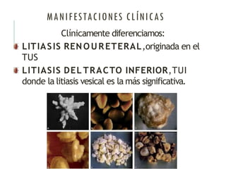 MANIFESTACIONES CLÍNICAS
Clínicamente diferenciamos:
LITIASIS RENOURETERAL,originada en el
TUS
LITIASIS DEL TRACTO INFERIOR,TUI
donde la litiasis vesical es la más significativa.
 