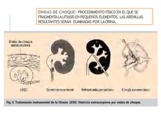 ONDAS DE CHOQUE: PROCEDIMIENTO FÍSICO EN EL QUE SE
FRAGMENTALALITIASIS EN PEQUEÑOS ELEMENTOS. LAS ARENILLAS
RESULTANTES SERÁN ELIMINADAS POR LAORINA.
 
