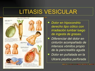 LITIASIS VESICULAR
           Dolor en hipocondrio
            derecho tipo cólico con
            irradiación lumbar luego
            de ingesta de grasas.
           Diferenciar del dolor en
            cinturón acompañado de
            intensos vómitos propio
            de la pancreatitis aguda
           Dolor en puñalada en la
            Ulcera péptica perforada
 