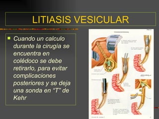LITIASIS VESICULAR
   Cuando un calculo
    durante la cirugía se
    encuentra en
    colédoco se debe
    retirarlo, para evitar
    complicaciones
    posteriores y se deja
    una sonda en “T” de
    Kehr
 