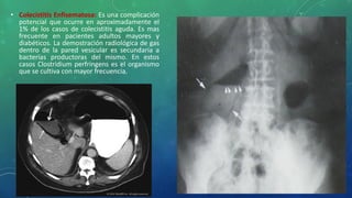 • Colecistitis Enfisematosa: Es una complicación
potencial que ocurre en aproximadamente el
1% de los casos de colecistitis aguda. Es mas
frecuente en pacientes adultos mayores y
diabéticos. La demostración radiológica de gas
dentro de la pared vesicular es secundaria a
bacterias productoras del mismo. En estos
casos Clostridium perfringens es el organismo
que se cultiva con mayor frecuencia.
 