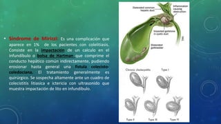 • Síndrome de Mirizzi: Es una complicación que
aparece en 1% de los pacientes con colelitiasis.
Consiste en la impactación de un calculo en el
infundíbulo o bolsa de Hartman que comprime el
conducto hepático común indirectamente, pudiendo
erosionar hasta general una fistula colecisto-
coledociana. El tratamiento generalmente es
quirúrgico. Se sospecha altamente ante un cuadro de
colecistitis litiasica e ictericia con ultrasonido que
muestra impactación de lito en infundíbulo.
 