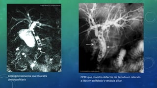 Colangioresonancia que muestra
coledocolitiasis
CPRE que muestra defectos de llenado en relación
a litos en colédoco y vesícula biliar.
 