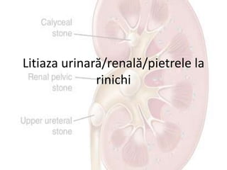 Litiaza urinară/renală/pietrele la
rinichi
 