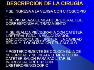 DESCRIPCIÓN DE LA CIRUGÍADESCRIPCIÓN DE LA CIRUGÍA
SE INGRESA A LA VEJIGA CON CITOSCOPIO
SE VISUALAZA EL MEATO URETERAL QUE
CORRESPONDA AL TRATAMIENTO
 SE REALIZA PIELOGRAFIA CON CATÉTER
URETERAL PARA LA VISUALIZACIÓN
RADIOSCÓPICA DEL URÉTER , LA CAVIDAD
RENAL Y LOCALIZACIÓN DEL CALCULO.
POSTERIORMENTE SE COLOCA GUÍA DE
SEGURIDAD Y SE DILATA EL MEATO CON
CATÉTER BALÓN PARA FACILITAR EL
INGRESO AL URÉTER CON
URETERORENOSCOPIO
 