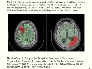 Masks of healthy (purple contours) and affected (yellow contours) brain tissues
and fragments emplacement for healthy and affected tissues (green and red
squares respectively) for FS = 16 (left) and 30 (right). Red color saturation
indicates the probability of assigning the fragment to the affected tissue.
Nedel’ko V et al. Comparative Analysis of Deep Neural Network and
Texture-Based Classifiers for Recognition of Acute Stroke using Non-Contrast
CT Images // 2020 Ural Symposium (USBEREIT). – IEEE, 2020, pp 376-379.
DOI:10.1109/USBEREIT48449.2020.9117784
37
 