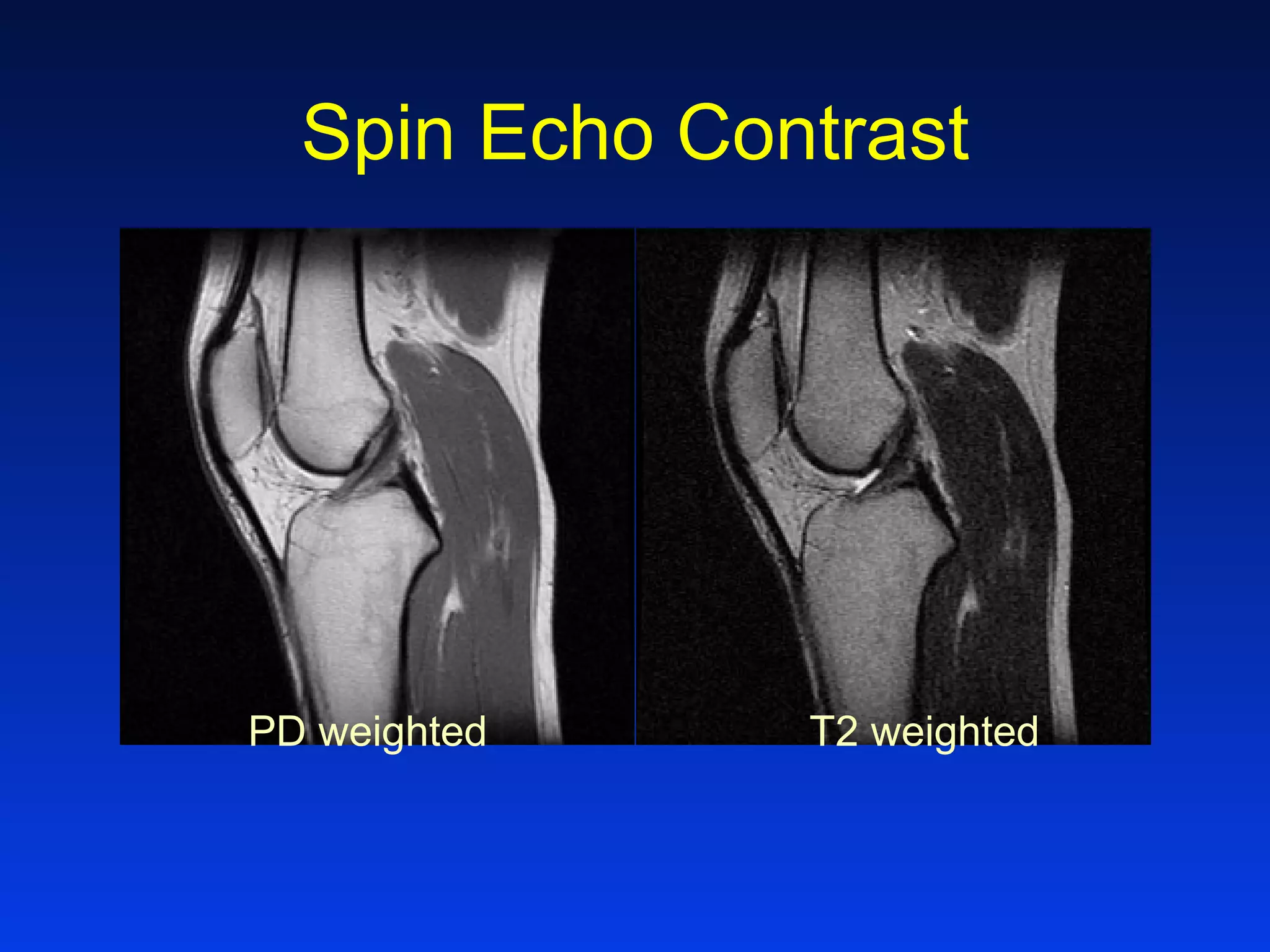 Spin Echo Contrast
PD weighted T2 weighted
 