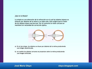 José María Olayo olayo.blogspot.com
¿Que es la Miopía?
La miopía es una alteración de la refracción en el cual los objetos lejanos se
enfocan por delante de la retina y no sobre ella. Esto origina que la visión
de los objetos lejano sea borrosa. Por el contrario la visión cercana se
mantiene sin necesidad de corrección óptica.
a) En el ojo miope, los objetos se situan por delante de la retina produciendo
una imagen desenfocada.
b) en cambio los objetos cercanos se proyectan sobre la retina produciendo
una imagen enfocada.
 