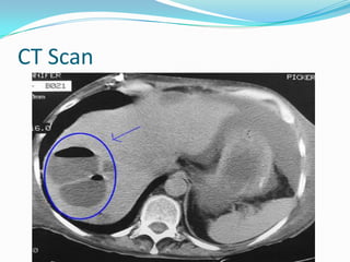 Live abscess | PPTX