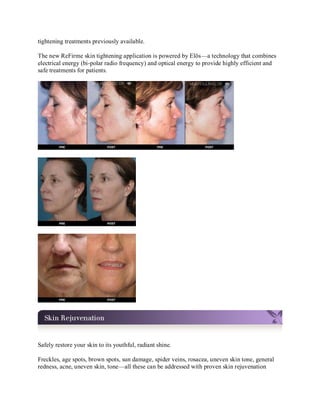 tightening treatments previously available.
The new ReFirme skin tightening application is powered by Elōs—a technology that combines
electrical energy (bi-polar radio frequency) and optical energy to provide highly efficient and
safe treatments for patients.

Safely restore your skin to its youthful, radiant shine.
Freckles, age spots, brown spots, sun damage, spider veins, rosacea, uneven skin tone, general
redness, acne, uneven skin, tone—all these can be addressed with proven skin rejuvenation

 