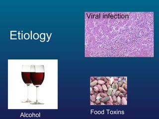 <ul><li>Etiology   </li></ul>Viral infection Alcohol   Food Toxins  
