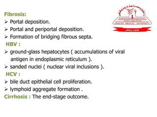 Fibrosis:
 Portal deposition.
 Portal and periportal deposition.
 Formation of bridging fibrous septa.
HBV :
 ground-glass hepatocytes ( accumulations of viral
antigen in endoplasmic reticulum ).
 sanded nuclei ( nuclear viral inclusions ).
HCV :
 bile duct epithelial cell proliferation.
 lymphoid aggregate formation .
Cirrhosis : The end-stage outcome.
 
