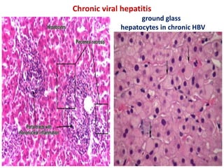 Chronic viral hepatitis
ground glass
hepatocytes in chronic HBV
 