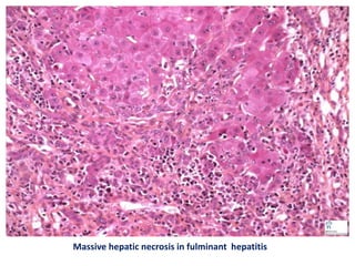 Massive hepatic necrosis in fulminant hepatitis
 