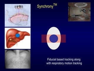 Synchrony
TM
Fiducial based tracking along
with respiratory motion tracking
 