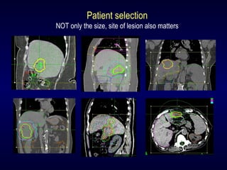 Patient selection
NOT only the size, site of lesion also matters
 