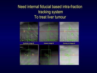 Need internal fiducial based intra-fraction
tracking system
To treat liver tumour
 