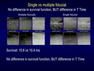 Single vs multiple fiducial
No difference in survival function, BUT difference in T Time
Multiple fiducials Single fiducial
Survival: 15.6 vs 10.4 mo
No difference in survival function, BUT difference in T Time
 