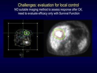 Challenges: evaluation for local control
NO suitable imaging method to assess response after CK,
need to evaluate efficacy only with Survival Function
 