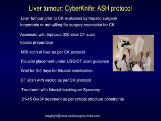 Liver tumour: CyberKnife: ASH protocol
Liver tumour prior to CK evaluated by hepatic surgeon
Inoperable or not willing for surgery counseled for CK
Assessed with triphasic 320 slice CT scan
Vacloc preparation
MRI scan of liver as per CK protocol
Fiducial placement under USG/CT scan guidance
Wait for 3-5 days for fiducial stabilization
CT scan with vacloc as per CK protocol
Treatment with fiducial tracking on Syncrony
21-45 Gy/3# treatment as per critical structure constraints
copyright@www.radiosurgery-india.com
 