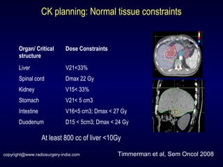 CK planning: Normal tissue constraints
Organ/ Critical
structure
Dose Constraints
Liver V21<33%
Spinal cord Dmax 22 Gy
Kidney V15< 33%
Stomach V21< 5 cm3
Intestine V16<5 cm3; Dmax < 27 Gy
Duodenum D15 < 5cm3; Dmax < 24 Gy
Timmerman et al, Sem Oncol 2008
At least 800 cc of liver <10Gy
copyright@www.radiosurgery-india.com
 