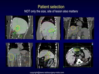 Patient selection
NOT only the size, site of lesion also matters
copyright@www.radiosurgery-india.com
 