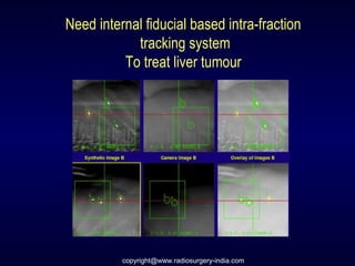 Need internal fiducial based intra-fraction
tracking system
To treat liver tumour
copyright@www.radiosurgery-india.com
 