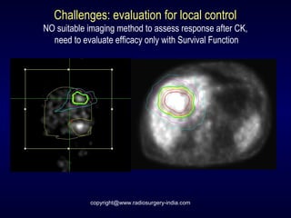 Challenges: evaluation for local control
NO suitable imaging method to assess response after CK,
need to evaluate efficacy only with Survival Function
copyright@www.radiosurgery-india.com
 