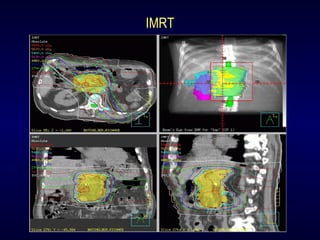 IMRT
 