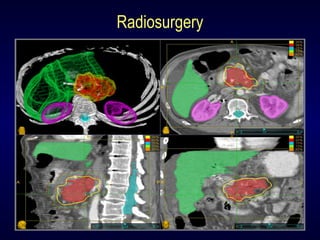 Radiosurgery
 