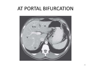 AT PORTAL BIFURCATION
20
IIIIV b
V
VI
 