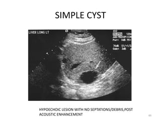 SIMPLE CYST
60
HYPOECHOIC LESION WITH NO SEPTATIONS/DEBRIS,POST
ACOUSTIC ENHANCEMENT
 