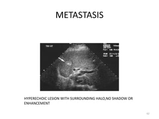 METASTASIS
62
HYPERECHOIC LESION WITH SURROUNDING HALO,NO SHADOW OR
ENHANCEMENT
 