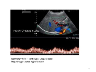 Normal pv flow – continuous ,hepatopetal
Hepatofugal- portal hypertension
64
 