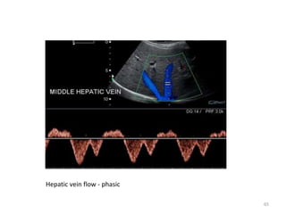 Hepatic vein flow - phasic
65
 