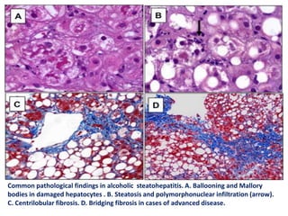 Common pathological findings in alcoholic steatohepatitis. A. Ballooning and Mallory
bodies in damaged hepatocytes . B. Steatosis and polymorphonuclear infiltration (arrow).
C. Centrilobular fibrosis. D. Bridging fibrosis in cases of advanced disease.
 