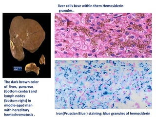 The dark brown color
of liver, pancreas
(bottom center) and
lymph nodes
(bottom right) in
middle-aged man
with hereditary
hemochromatosis .
liver cells bear within them Hemosiderin
granules .
Iron(Prussian Blue ) staining: blue granules of hemosiderin
 