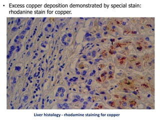 • Excess copper deposition demonstrated by special stain:
rhodanine stain for copper.
Liver histology - rhodamine staining for copper
 