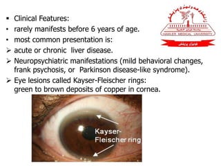  Clinical Features:
• rarely manifests before 6 years of age.
• most common presentation is:
 acute or chronic liver disease.
 Neuropsychiatric manifestations (mild behavioral changes,
frank psychosis, or Parkinson disease-like syndrome).
 Eye lesions called Kayser-Fleischer rings:
green to brown deposits of copper in cornea.
 