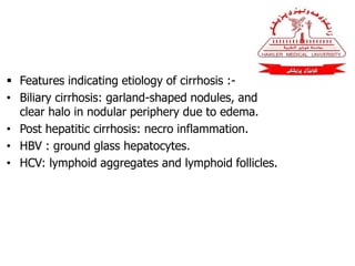  Features indicating etiology of cirrhosis :-
• Biliary cirrhosis: garland-shaped nodules, and
clear halo in nodular periphery due to edema.
• Post hepatitic cirrhosis: necro inflammation.
• HBV : ground glass hepatocytes.
• HCV: lymphoid aggregates and lymphoid follicles.
 