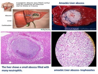 The liver shows a small abscess filled with
many neutrophils.
Amoebic Liver abscess
amoebic Liver abscess- trophozoites
 