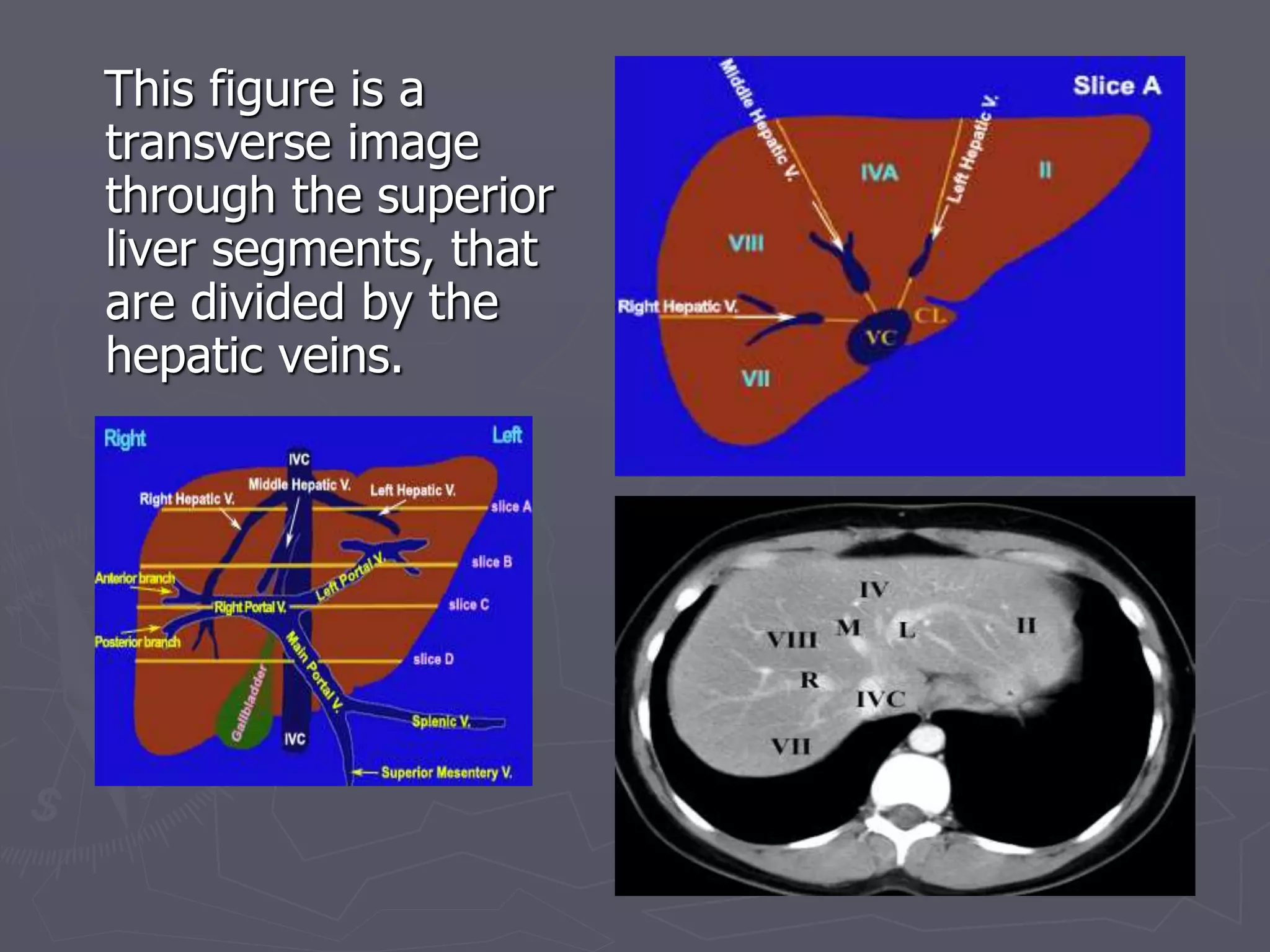 This figure is a
transverse image
through the superior
liver segments, that
are divided by the
hepatic veins.
 